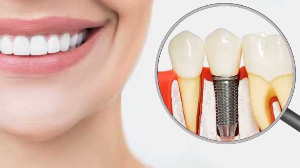 Dental Implants for Stronger Smile&nbsp;Restoration